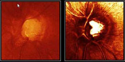 Représentation 2D de la tête du nerf optique obtenue à l’aide du HRT